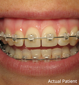 Clear Braces in Hoover — What Are Clear Braces?— Clear Braces Near